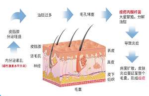 重度痤瘡，痤瘡結(jié)節(jié)硬塊注意哪些飲食禁忌