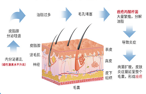 對(duì)付痤瘡其實(shí)沒(méi)有那么難，奧絡(luò)乳膏使用方法要記牢