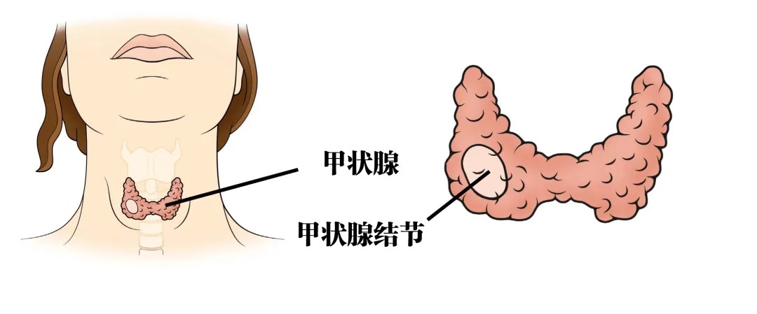 國內甲狀腺結節群體已超2億？他們可能都有這個通病