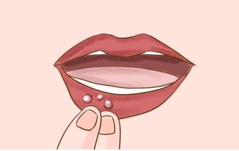 口腔溃疡起泡擦什么药膏效果比较好？