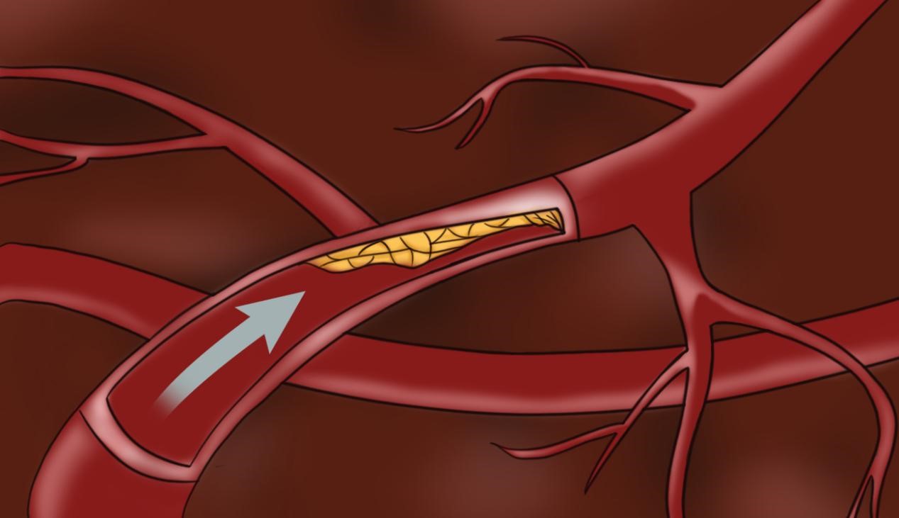 健康科普：頸動脈斑塊怎么形成的
