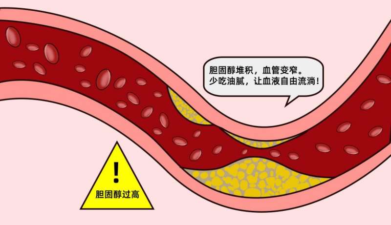 頸動脈斑塊會引起哪些癥狀