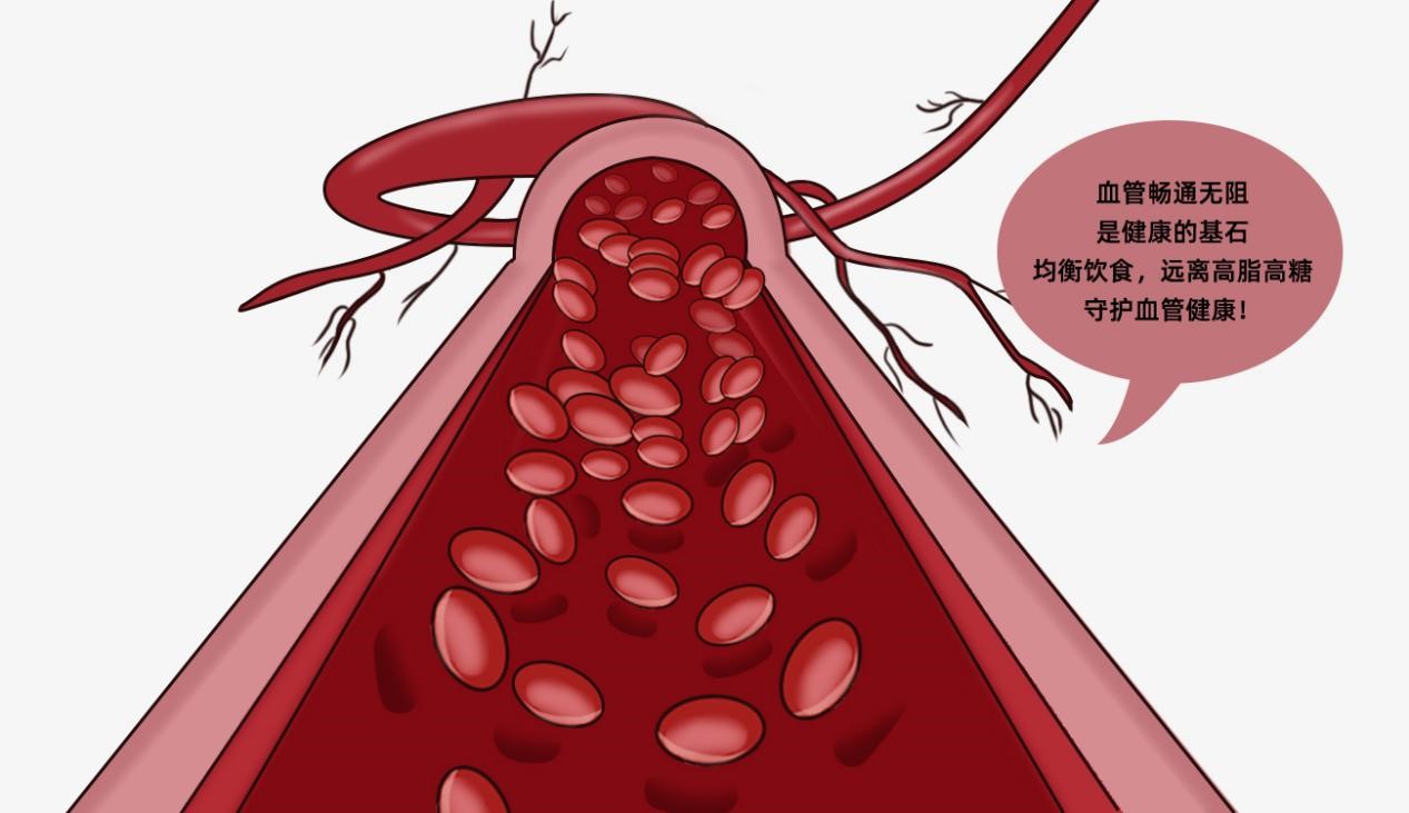 頸動脈斑塊是怎樣形成的