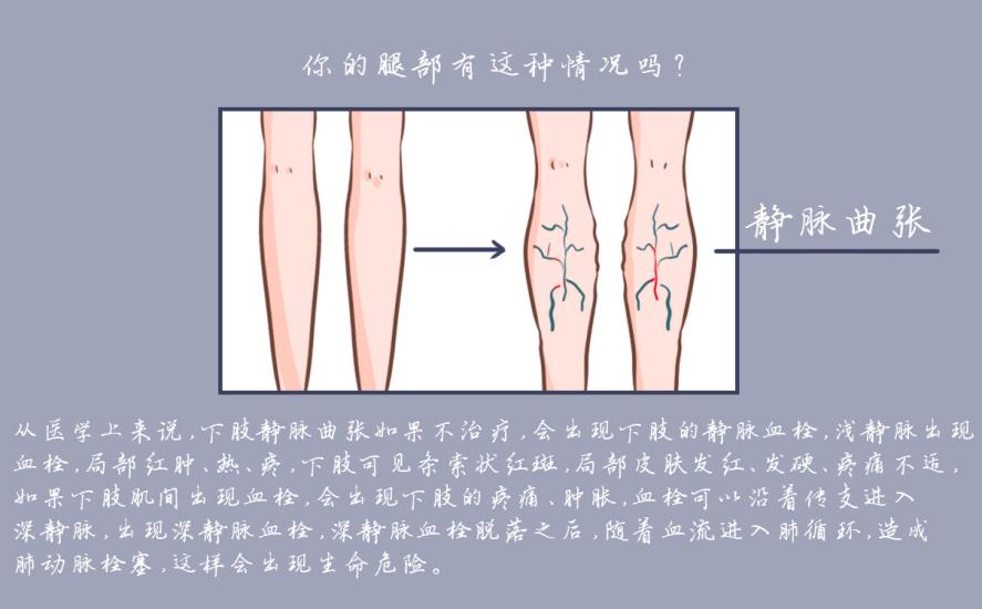 靜脈曲張彈力襪什么牌子的好