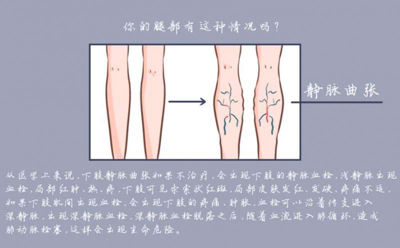 靜脈曲張穿邁迪靜脈曲張襪多久見效